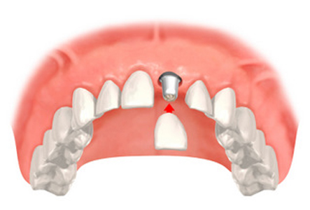 Ersatz von einzelnen Zähnen
